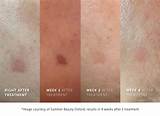 Before and After Cryotherapy Pictures: See the Transformation