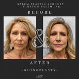 Cosmetic Surgery Revelations in Winston-Salem