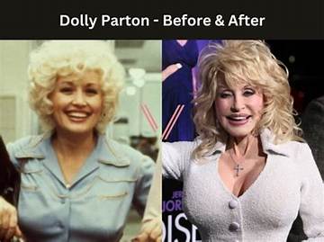 Dolly Parton: Uncovering the Truth About Implants
