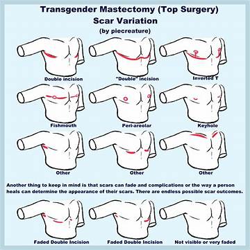 Effective Healing Techniques for Mastectomy Scars: a Comprehensive Guide