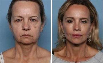 Exploring the World of Plastic Surgery Comparison: a Deep Dive