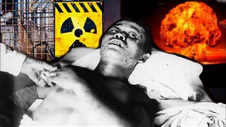 Horrific Radiation Poisoning: the Tragic Case of Hisashi Ouchi