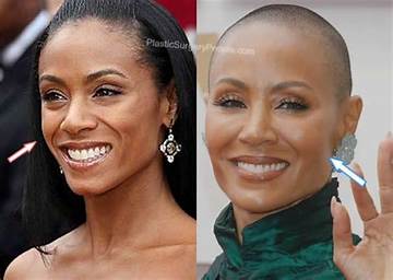Jada Pinkett Smith's Cheek Implants: a Comprehensive Guide