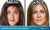 Jennifer Aniston Face Surgery