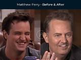 Matthew Perry's Nose Job: a Transformation Examined