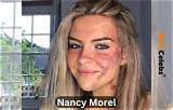 Nancy Morel Skin Condition, What Is Her Illness? Health Update