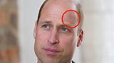 Prince William's Head Injury Raises Concerns About Royal Health and Public Safety